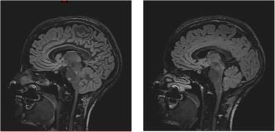 Cardiogenic shock due to reverse takotsubo syndrome triggered by multiple sclerosis brainstem lesions: a case report and mini review